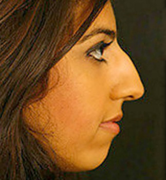Rhinoplasty Patient Photo - Case 5918 - before view-0
