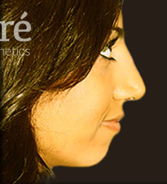 Rhinoplasty Patient Photo - Case 5918 - after view-0