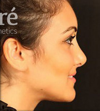 Rhinoplasty Patient Photo - Case 5923 - after view