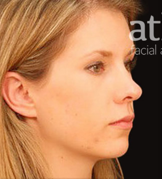 Rhinoplasty Patient Photo - Case 5928 - before view-