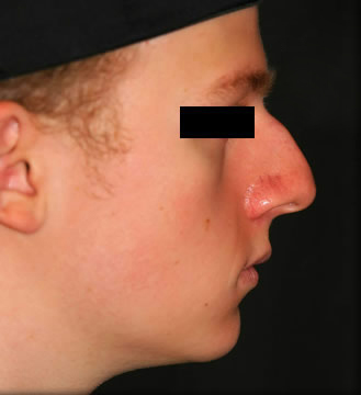 Rhinoplasty Patient Photo - Case 5933 - before view-0