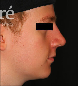 Rhinoplasty Patient Photo - Case 5933 - after view