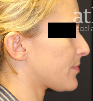 Rhinoplasty Patient Photo - Case 5780 - before view-