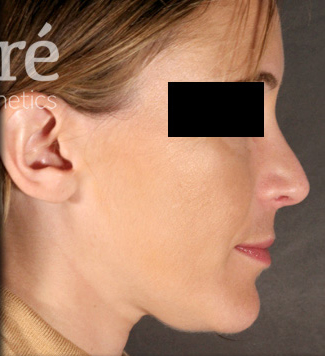 Rhinoplasty Patient Photo - Case 5780 - after view