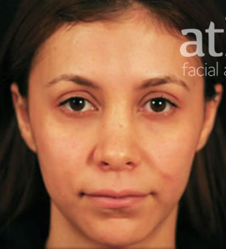 Revision Rhinoplasty Patient Photo - Case 5986 - before view-1