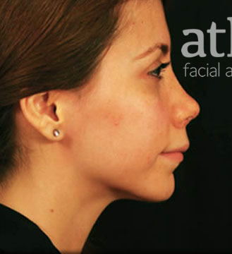 Revision Rhinoplasty Patient Photo - Case 5986 - before view-