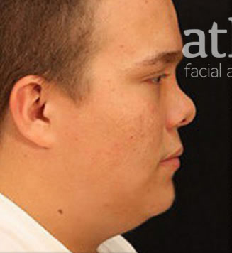 Revision Rhinoplasty Patient Photo - Case 5995 - before view-0
