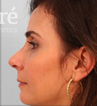 Revision Rhinoplasty Patient Photo - Case 6000 - after view