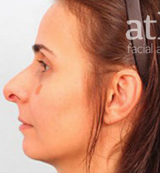 Revision Rhinoplasty Patient Photo - Case 6000 - before view-0