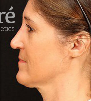 Revision Rhinoplasty Patient Photo - Case 6008 - after view-0