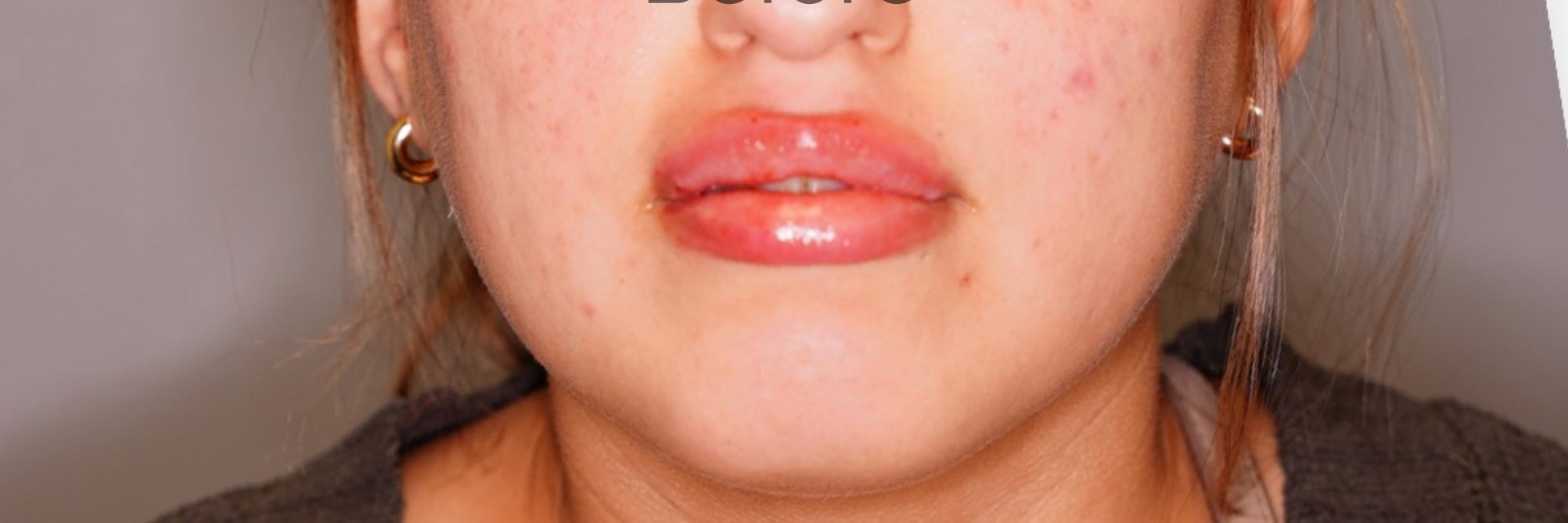 Lip Lift Patient Photo - Case 6038 - after view-0