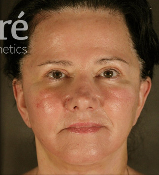 Brow Lift Patient Photo - Case 6053 - after view