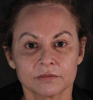 Eyelid Surgery Patient Photo - Case 6178 - before view-1