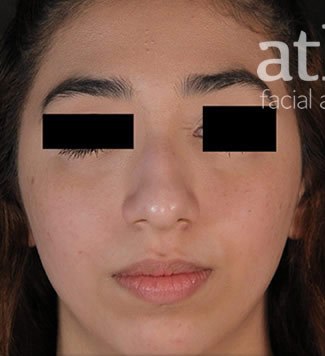 Chin Augmentation Patient Photo - Case 6295 - before view-2