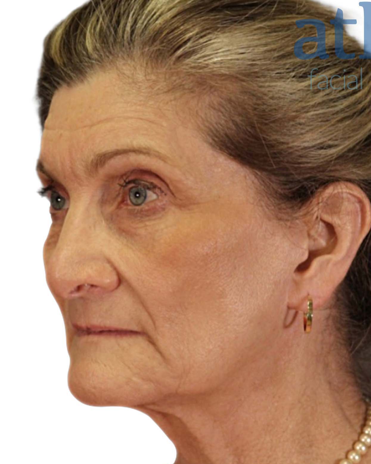 Brow Lift Patient Photo - Case 6294 - before view-