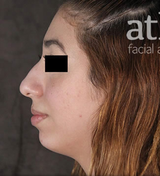 Chin Augmentation Patient Photo - Case 6295 - before view-0