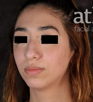 Chin Augmentation Patient Photo - Case 6295 - before view-1