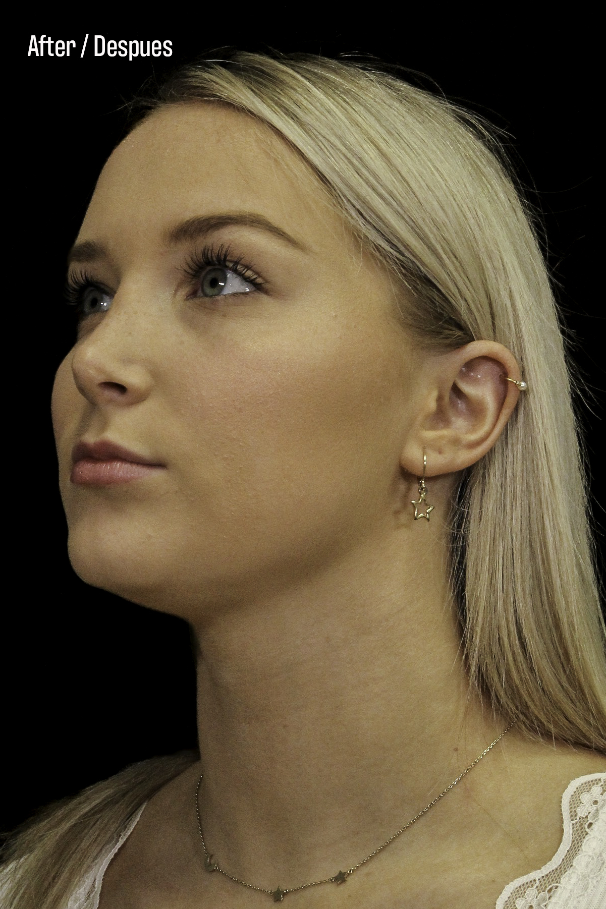 Rhinoplasty Patient Photo - Case 6371 - after view-1
