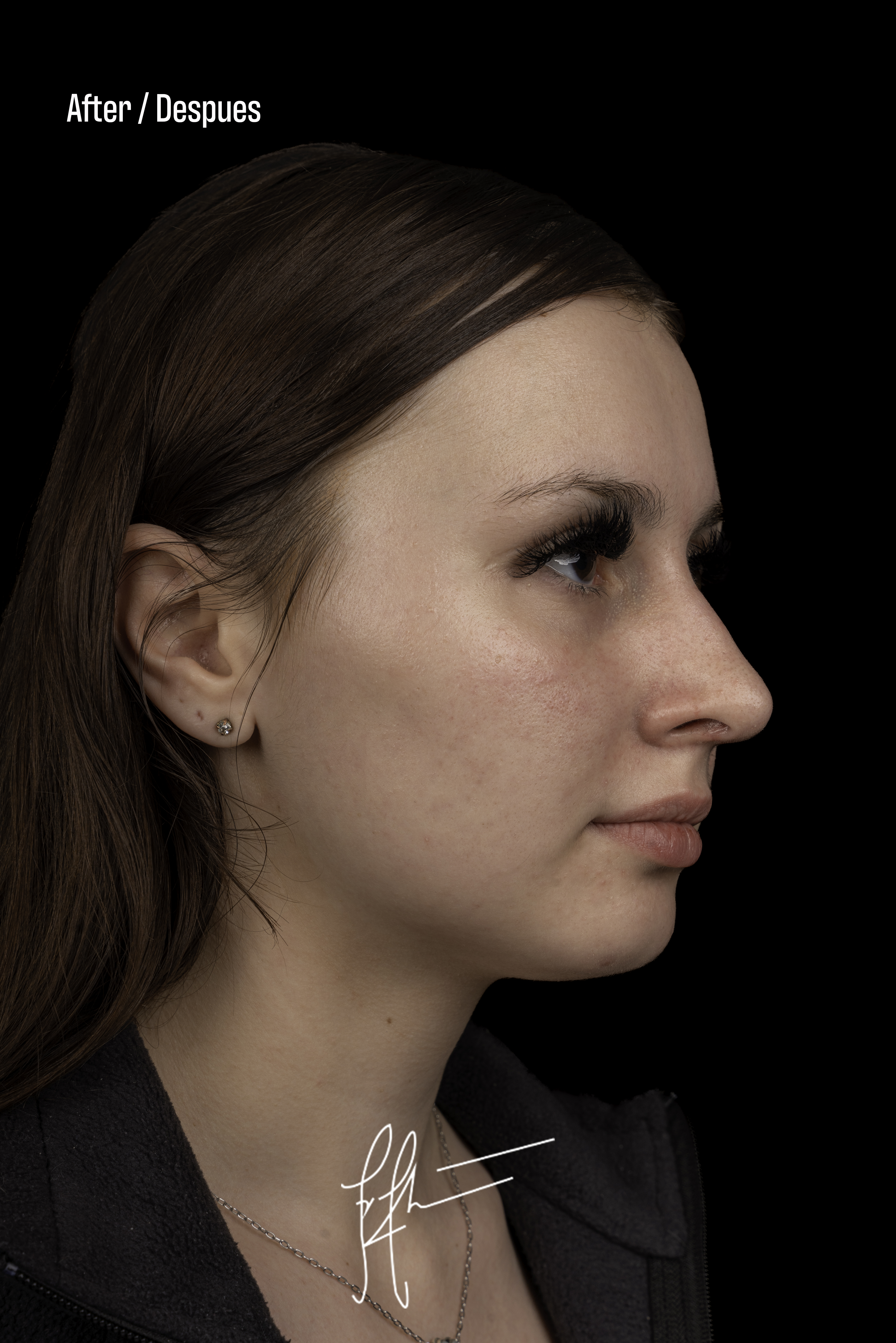 Rhinoplasty Patient Photo - Case 6369 - after view-1