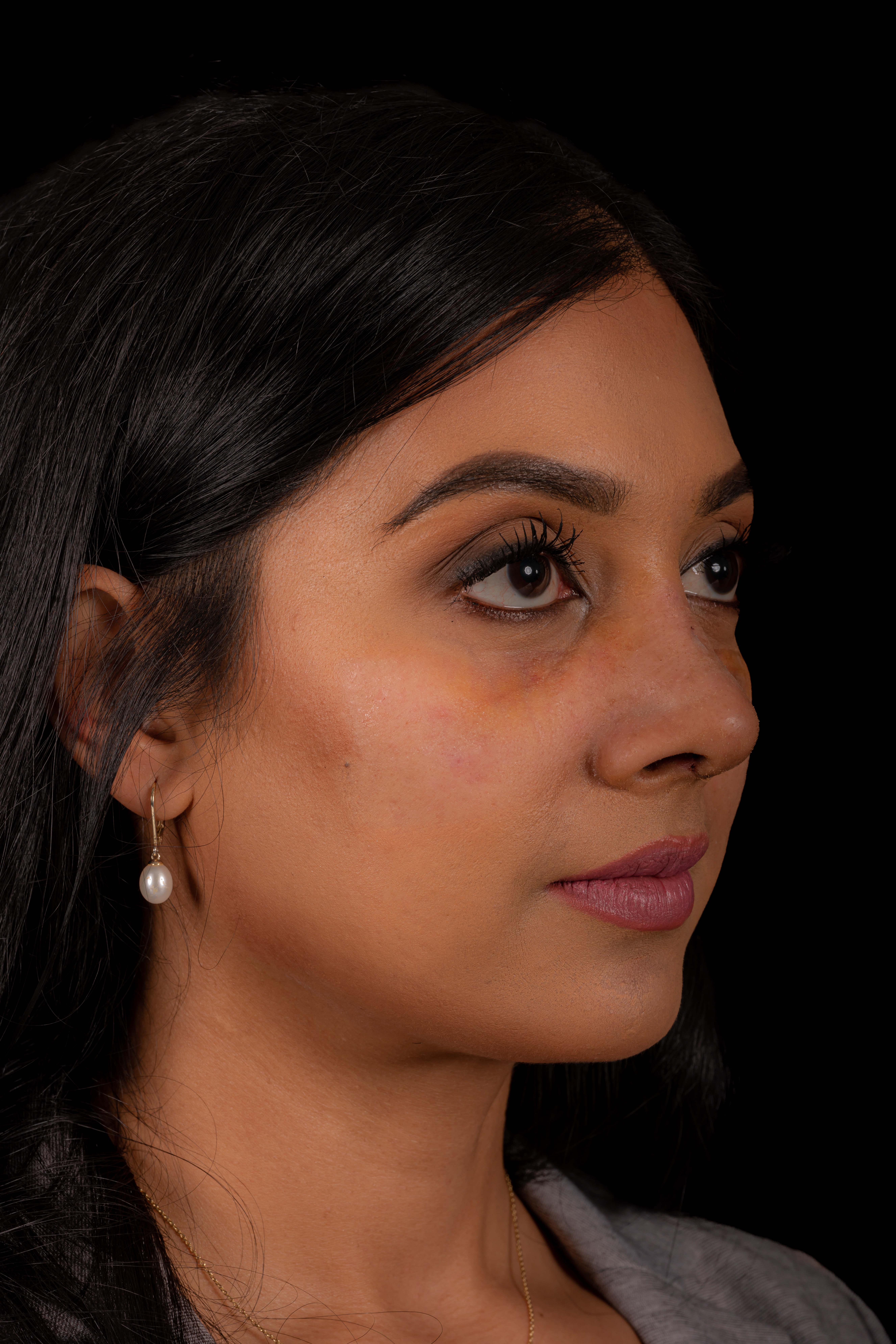Rhinoplasty Patient Photo - Case 6440 - after view-2