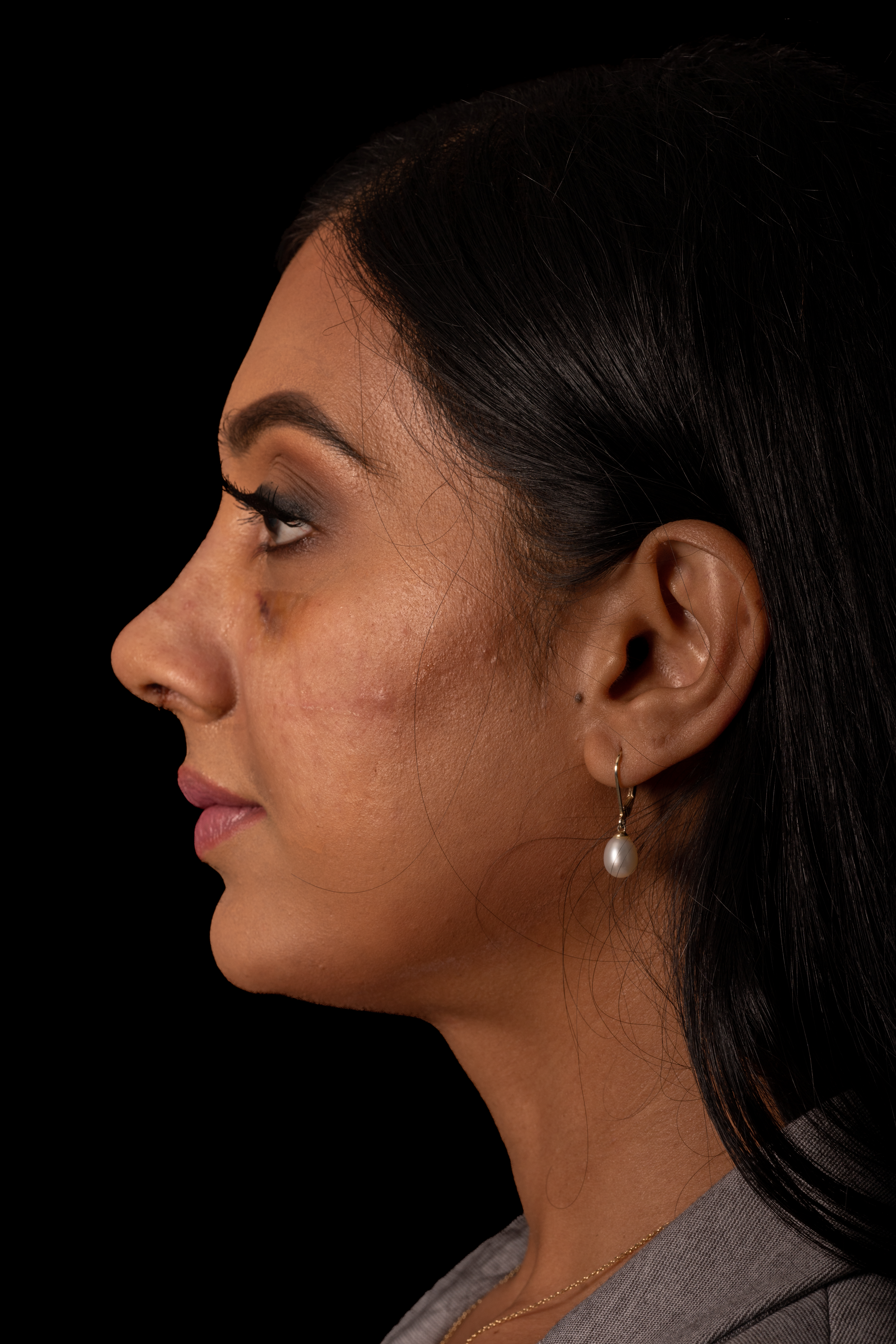 Rhinoplasty Patient Photo - Case 6440 - after view-4