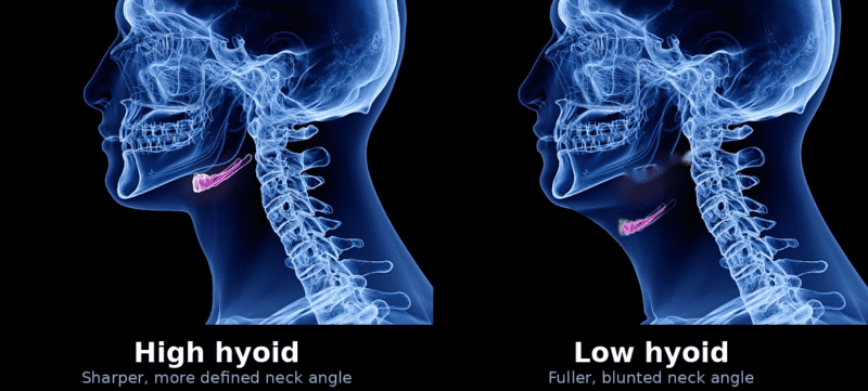 High hyoid vs. low hyoid