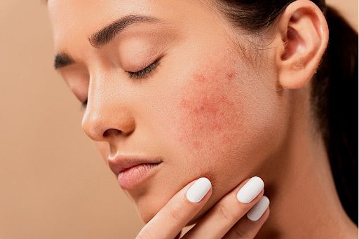 woman with acne on her chin