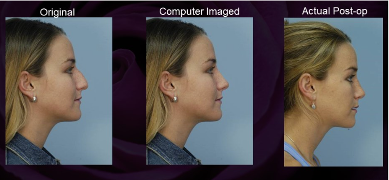 3D-nose-surgery