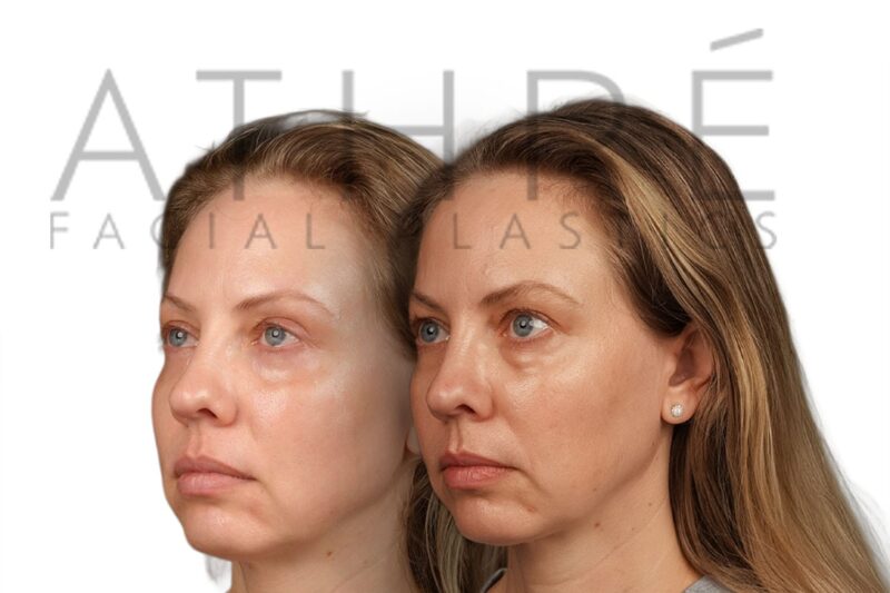 Before and after female upper blepharoplasty results by Dr. Raghu Athré.