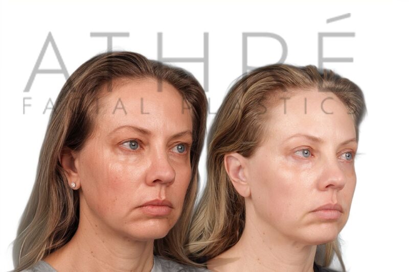 Before and after upper eyelid surgery by Dr. Raghu Athré.