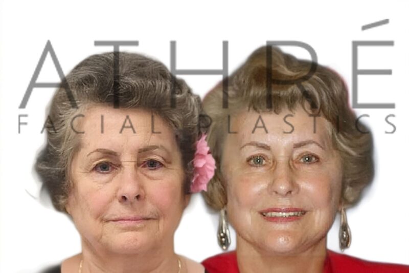 70 year old female before and after blepharoplasty by Dr. Raghu Athré.