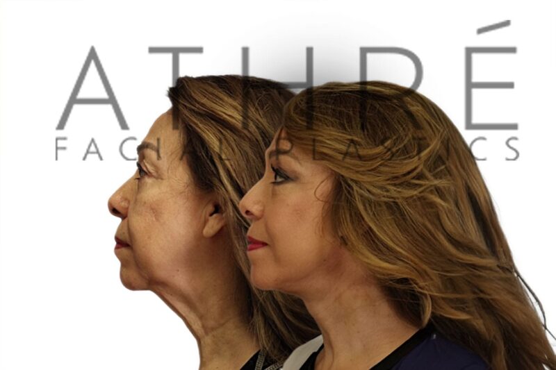 Before and after upper eyelid surgery and midface rejuvenation by Dr. Raghu Athré