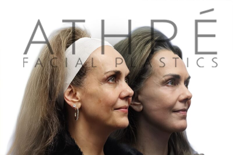 Before and after lower eyelid laser resurfacing and blepharoplasty by Dr. Raghu Athré.