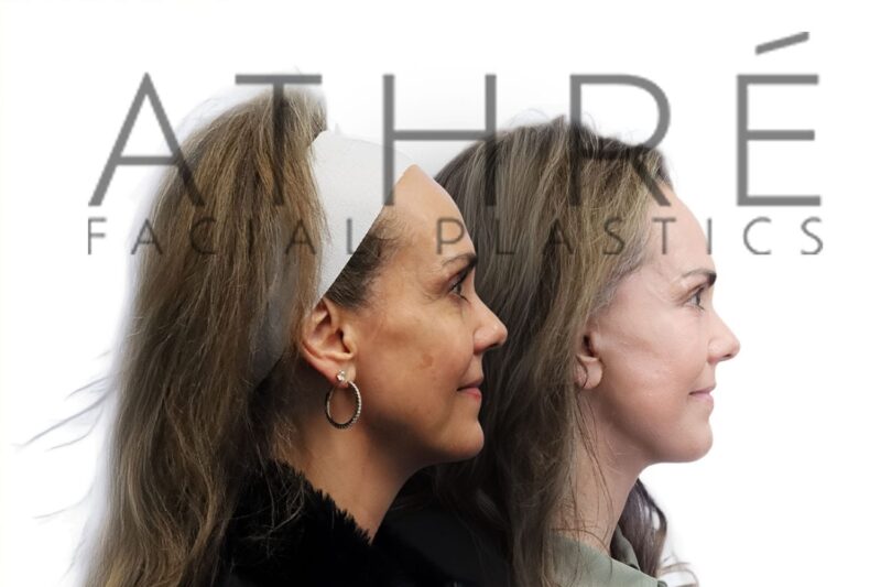 Female before and after four lid eyelid surgery by Dr. Raghu Athré