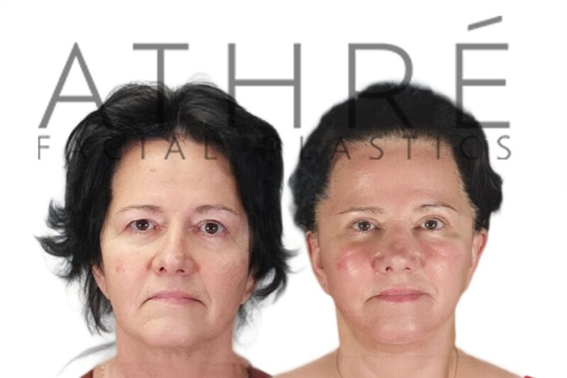 Before and after upper and lower blepharoplasty with midface lift by Dr. Raghu Athré.