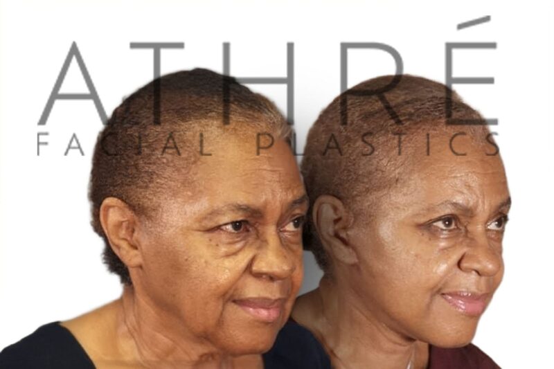 Female before and after upper blepharoplasty by Dr. Raghu Athré.