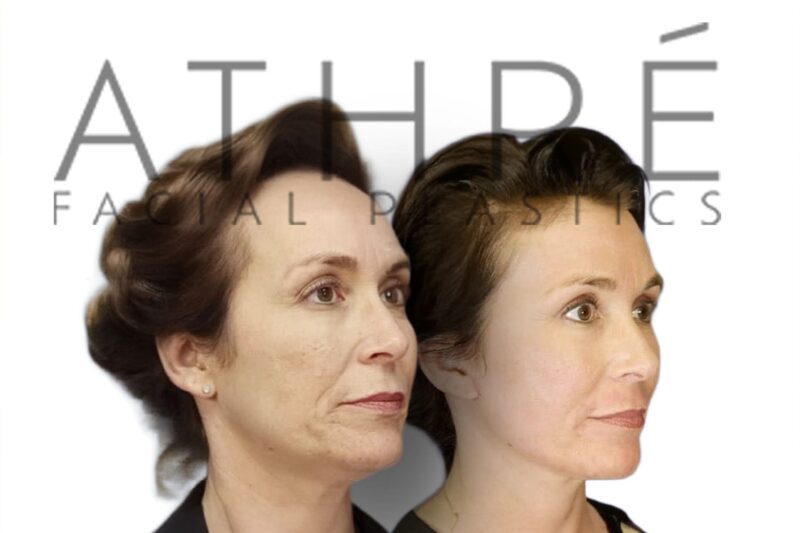 Female patient before and after blepharoplasty and neck lift by Dr. Raghu Athré.