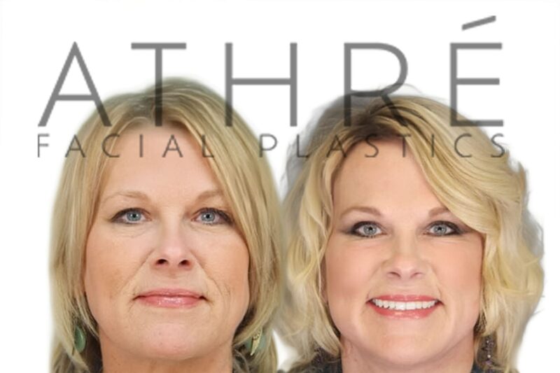 Before and after upper and lower blepharoplasty with fat grafting by Dr. Raghu Athré.