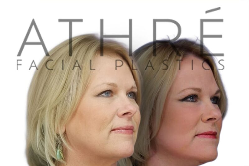 Female patient before and after blepharoplasty and midface fat transfer by Dr. Raghu Athré.