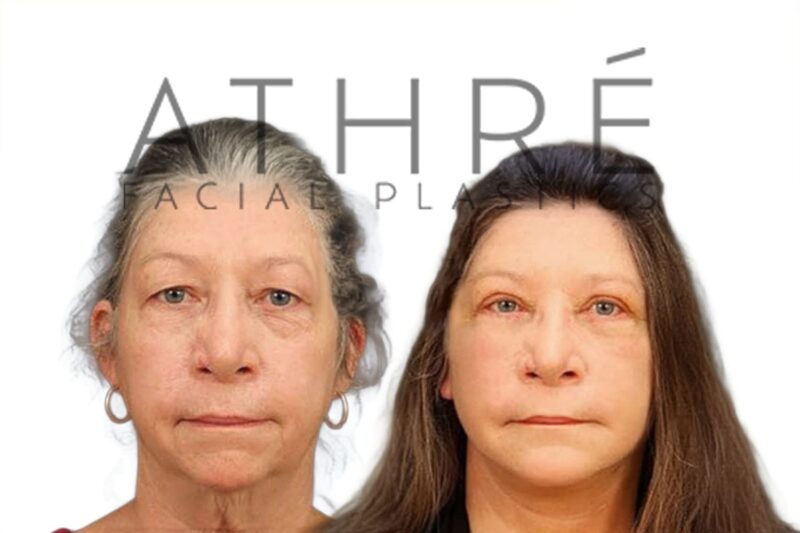 Before and after four lid blepharoplasty with canthopexy by Dr. Raghu Athré.