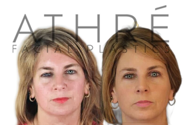 Before and after ptosis repair and blepharoplasty by Dr. Raghu Athré.