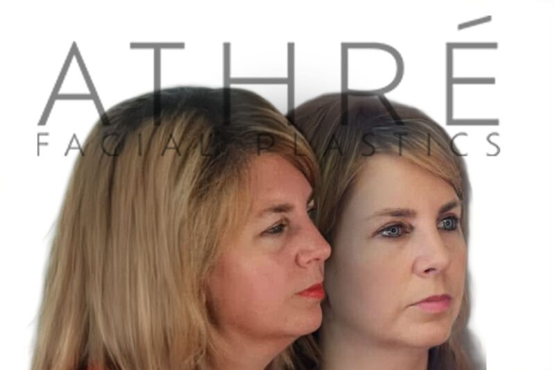 Female patient before and after eyelid ptosis repair by Dr. Raghu Athré.