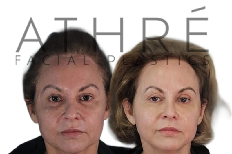Before and after lower eyelid laser blepharoplasty and chemical peel by Dr. Raghu Athré.