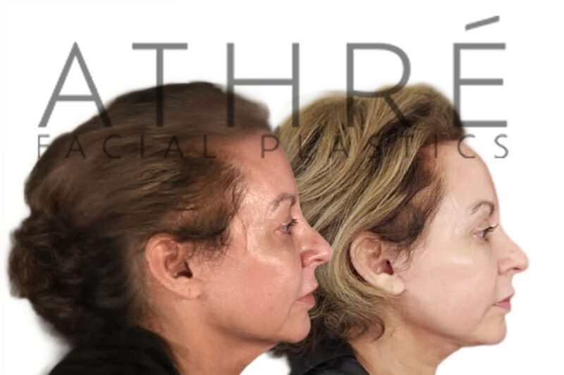 Female patient before and after lower eyelid rejuvenation by Dr. Raghu Athré.
