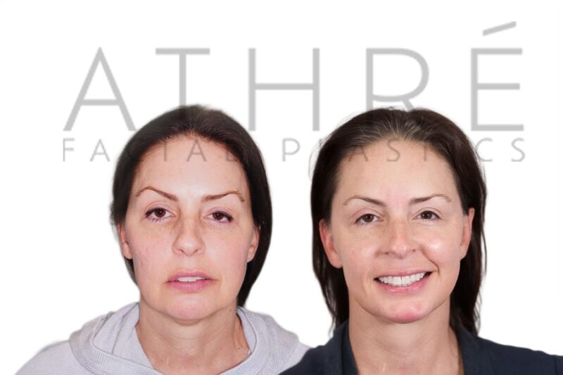 Before and after lower eyelid laser blepharoplasty and facelift by Dr. Raghu Athré.