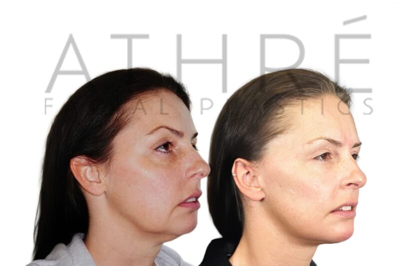 Before and after deep plane facelift and lower blepharoplasty by Dr. Raghu Athré.