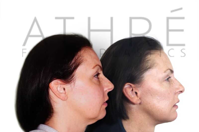 Before and after lower eyelid rejuvenation and neck lift by Dr. Raghu Athré.