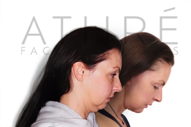 Female patient before and after facelift and lower eyelid surgery by Dr. Raghu Athré.