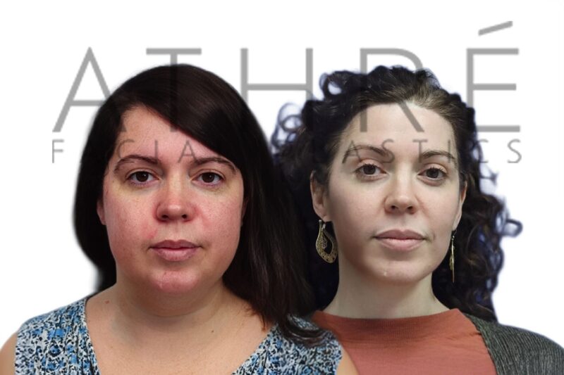 Before and after upper blepharoplasty facelift and neck lift by Dr. Raghu Athré.