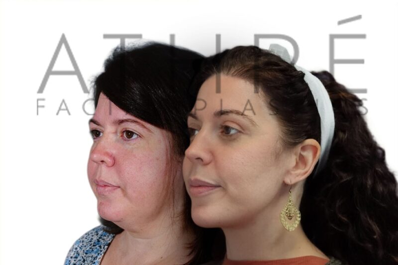 Young female before and after upper eyelid blepharoplasty and 4D Facelift by Dr. Raghu Athré.